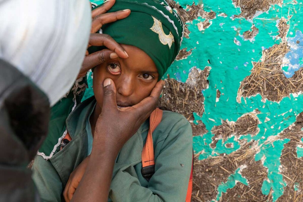 primo piano di una bambina con tracoma in visita oculistica