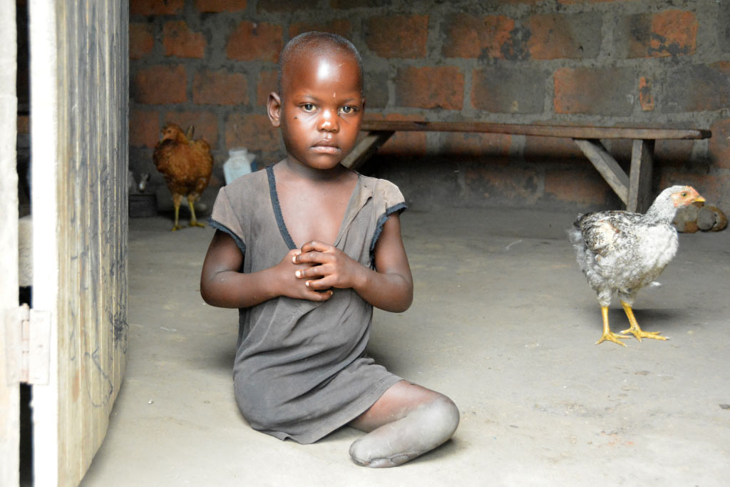 bambina con malformazione alla gamba
