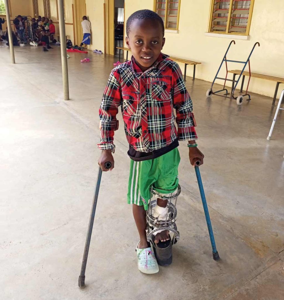 bambino con stampelle e protesi