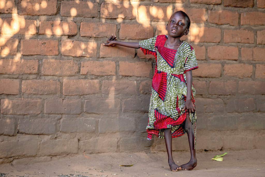 bambina con i piedi torti si appoggia al muro