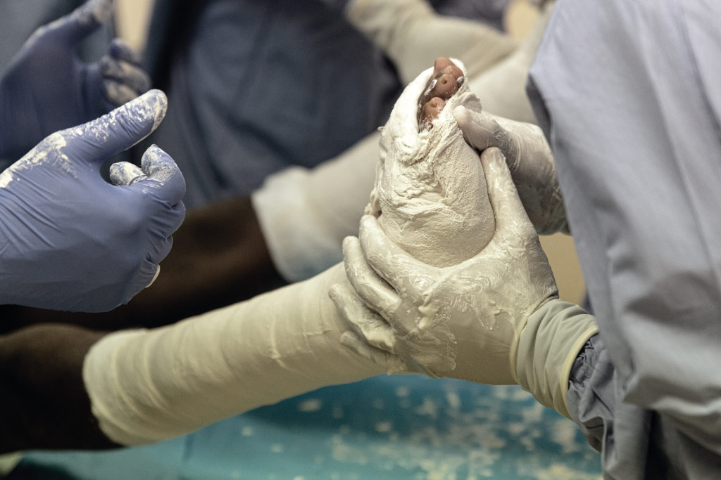 medici applicano il gesso