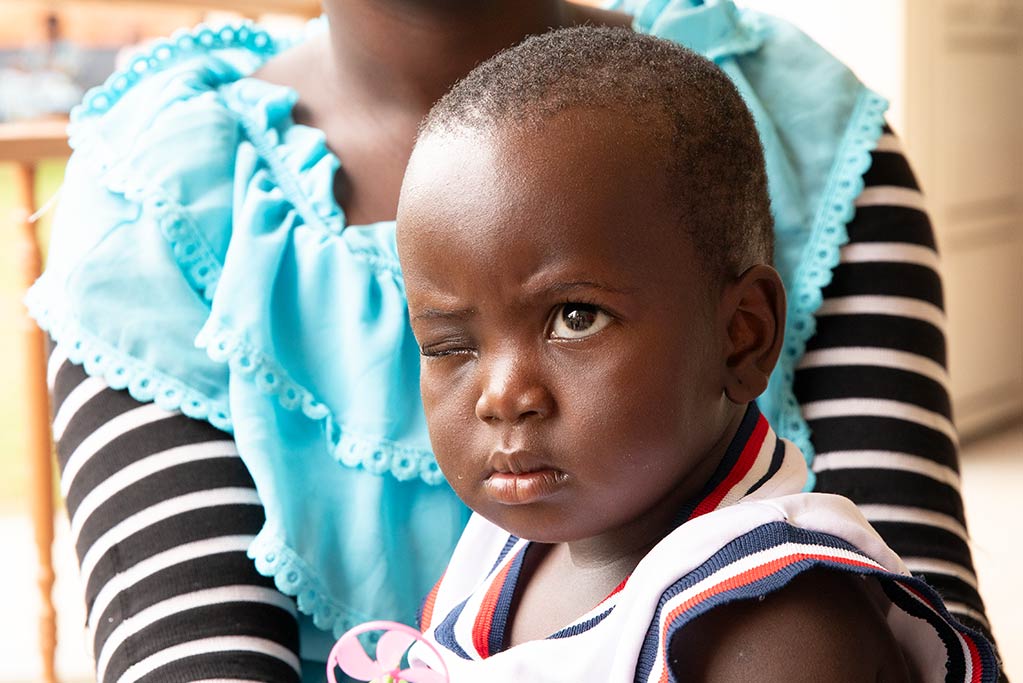 primo piano bimba senza occhio destro