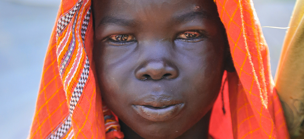 primo piano di bimba sudsudanese con tracoma